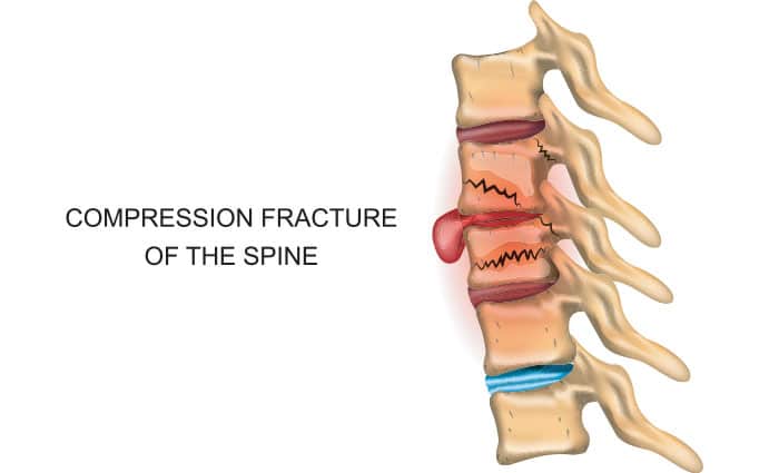 Spinal Compression Fractures  Advanced Orthopaedics & Sports