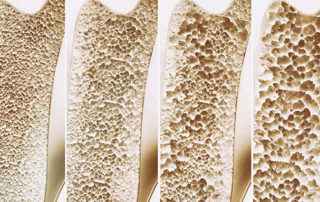 cross section of human bones showing advancing stages of osteoporosis