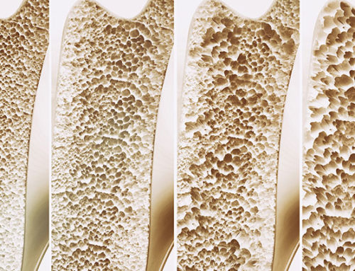 Osteoporosis: What You Should Know at All Ages