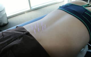 Dry Needling at Cary Ortho