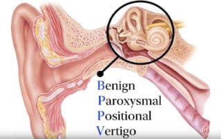 Patient-Education Series Benign Paroxysmal Positional Vertig