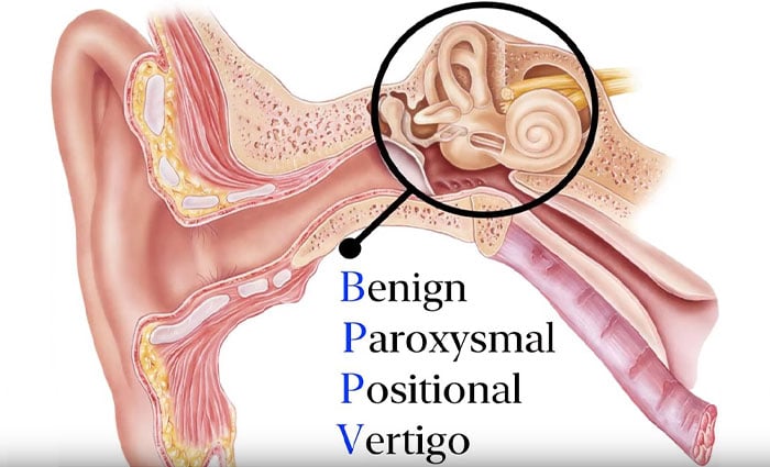 Patient Education Series Benign Paroxysmal Positional Vertigo