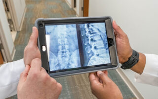 What is a Spinal Fusion?