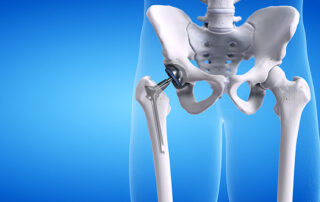 What is a Total Hip Replacement