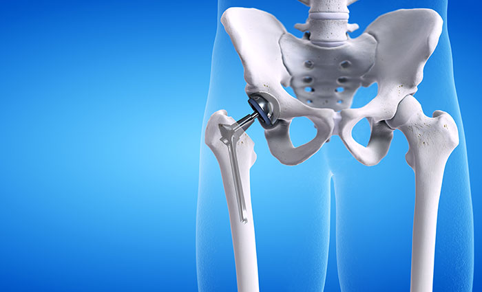 After Hip Replacement: Continuing with Hospital Recovery