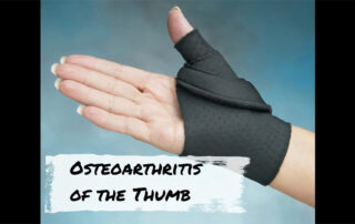 Occupational therapy can help to address these issues. Patient education, modification and joint protection are all vital when treating osteoarthritis of the thumb.