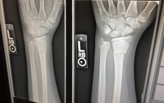 What's the Difference Between a Fracture and a Break?