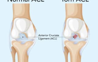 Detailed vector illustration of a normal and torn ACL in the human knee, highlighting anatomical differences with clear labeling