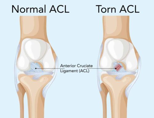 Signs and Symptoms of ACL Tears in Active Individuals