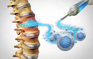 Image example of orthopedic stem cell therapy used for back pain.