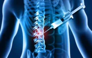 3D illustration image of spinal injection as a medication and treatment for human spine diseases and prolapsed discs.