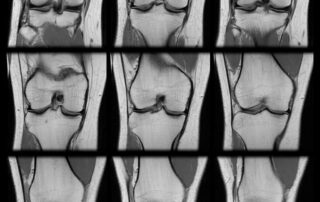 Series of MRI knee scans of a torn ACL of an adult human female.