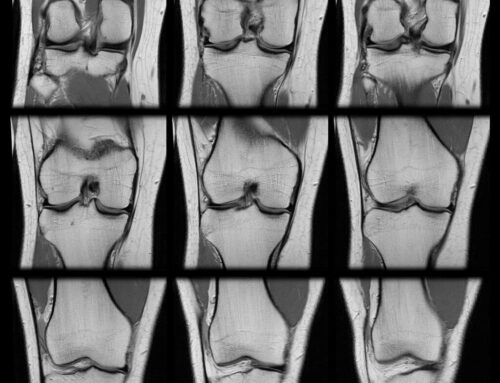 ACL Tear Diagnosis: When Do You Need a Knee MRI?