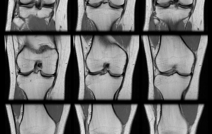 Series of MRI knee scans of a torn ACL of an adult human female.