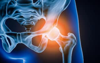 Front-facing (anterior) view of the human hip joint and surrounding bones, depicted as a 3D-rendered illustration highlighting inflammation or injury.