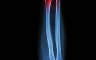 X-ray image of a bone fracture.