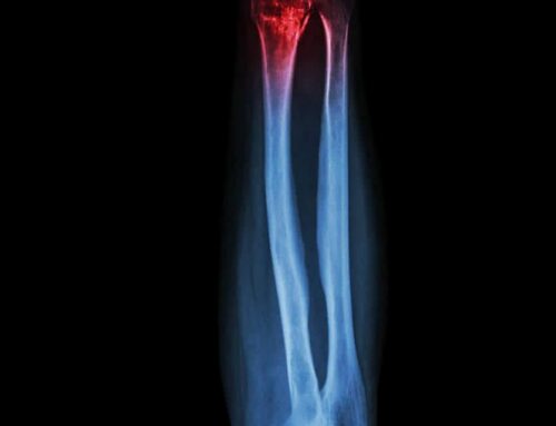Can Urgent Care X-Ray Your Suspected Fracture?