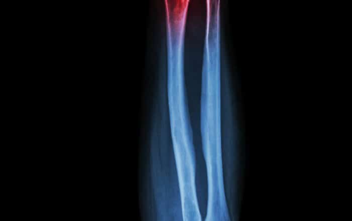 X-ray image of a bone fracture.