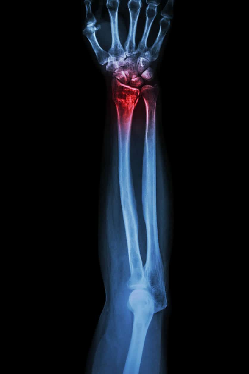 X-ray image of a bone fracture.
