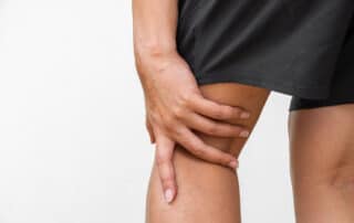 Close-up of sprain near knee fold.