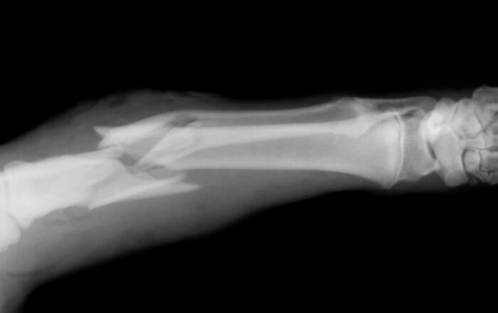 X-ray of a Broken Bone