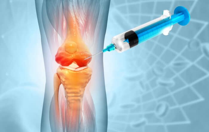 3d illustration of stem cell therapy for arthritis pain in the knee.