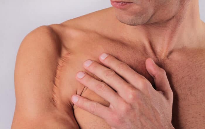 Man man with scar on hand shoulder from a shoulder surgery.