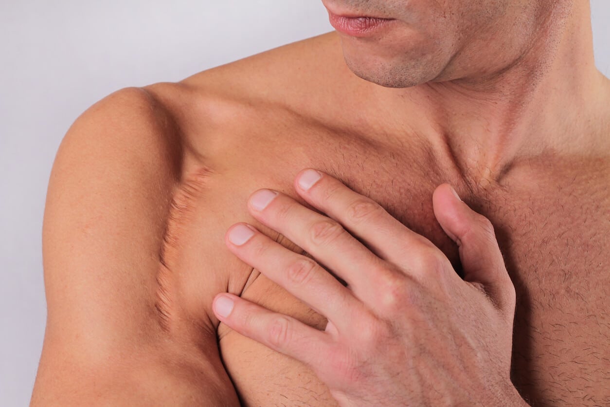Man man with scar on hand shoulder from a shoulder surgery.
