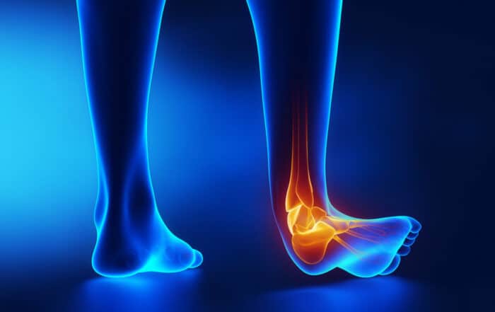 Sprained ankle blue x-ray